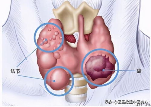 患者心声 甲状腺结节终于消了,但愿此生再也不见