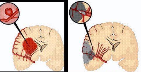 辟谣 脑中风就是脑梗 不全面,脑梗只是脑中风的一种