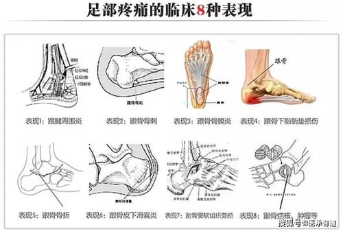 介绍一个化解足跟骨刺 足跟痛的 神方 ,只需两味药