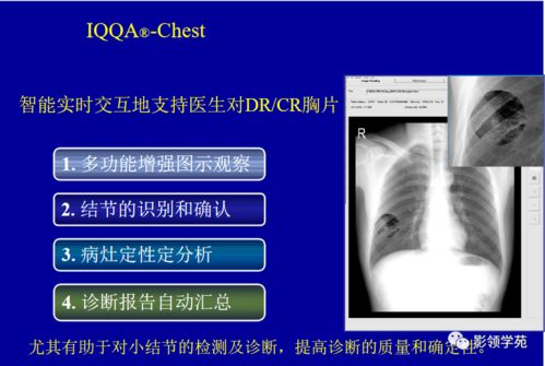 偶发性肺结节影像诊断方法评估与处置原则