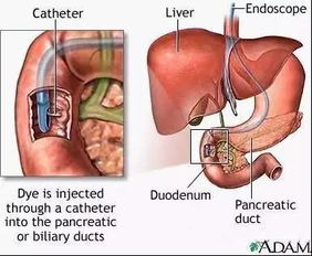 胰腺癌 你可能得了假的糖尿病