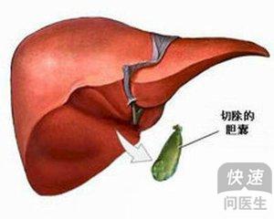 胆结石切除胆囊后饮食禁忌