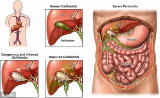 胆囊对人体有多重要 摘除有何后果 胆囊摘除3大疑问一次说清 