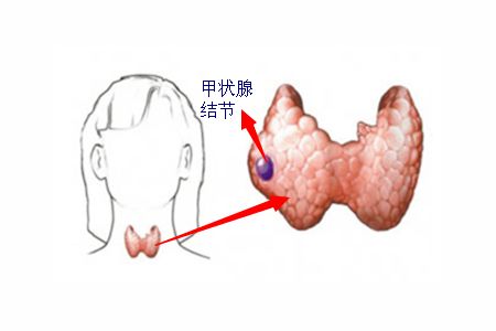 首大李金华 甲状腺结节 不是最终的诊断