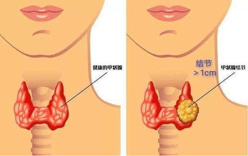 牛肉,是结节的 催化剂 吗 内科主任 不想结节癌变,少做4事