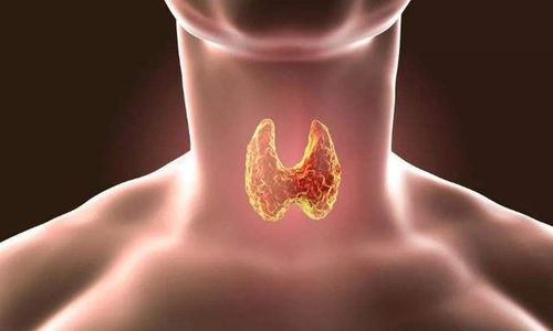 20多岁得甲状腺癌能活50年吗,医生 注意4件事,可能会活的更久