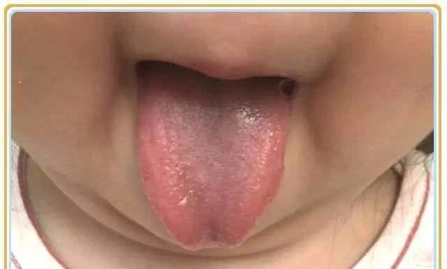 孩子出现 草莓舌 是怎么回事 常见的这几个原因,不妨一一排查 