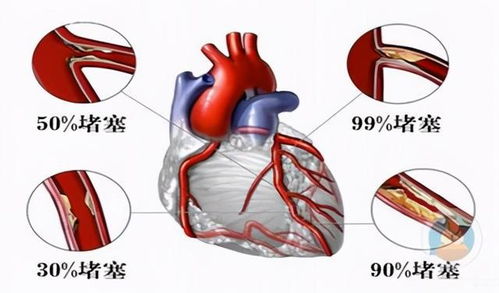 发现 动脉斑块 ,还能逆转或消失吗 心脏医生给出靠谱答复