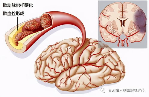 突发脑梗病情急,介入治疗显神奇