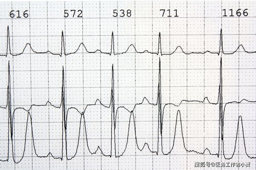 高血压长期得不到控制要做心电图
