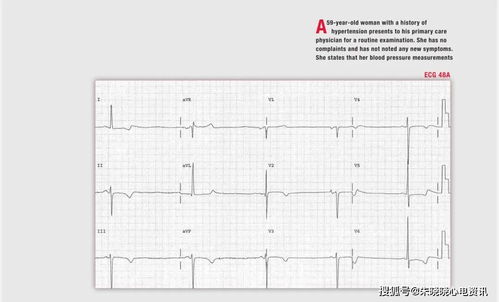 既往高血压患者,两次心电图为何有所不同