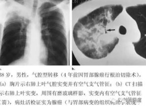 12种非典型肺转移瘤的影像学表现 