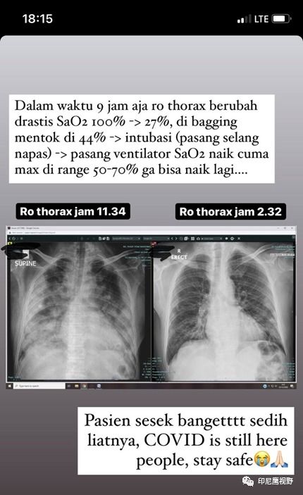 医生拍下X光片,印尼新冠患者9小时肺部变化令人震惊......