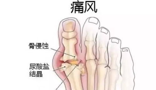 尿酸偏高拖不得,这3种食物堪称 降酸王 吃了就知好