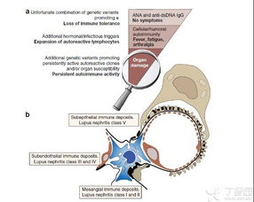 从病理生理角度来理解狼疮肾炎的诊断及治疗