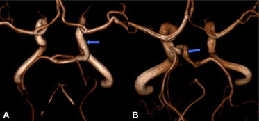 图文综述 脑供血动脉变异之形态 路径变异