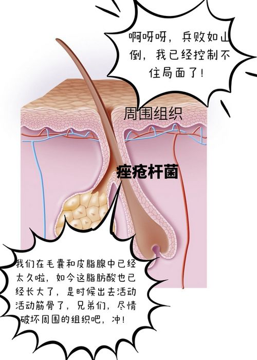 青春痘疫苗要来了 我十多年的痘痘真的有天敌了吗