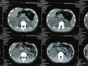 肝脏脓肿误诊肾脏肿瘤一例