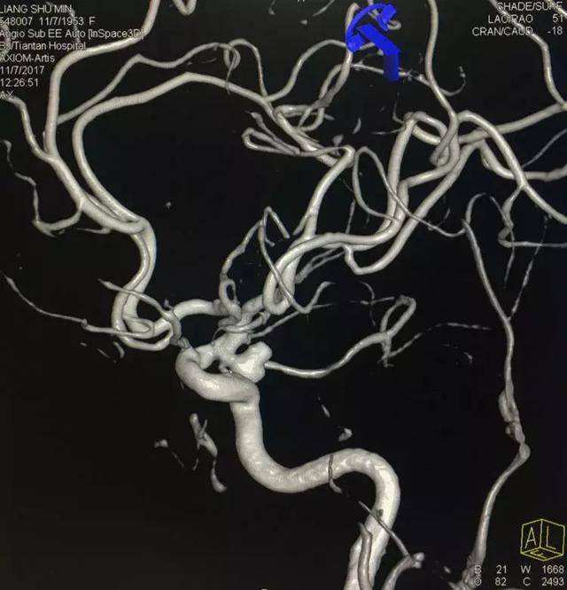 辽宁55岁女子唱 青藏高原 脑动脉瘤破裂,防动脉瘤破裂三不要