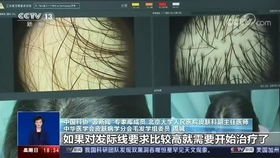 武汉女白领每天喝3斤白酒连喝9年 身体变化惊住医生