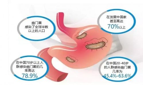 请警惕 我国超一半人感染幽门螺杆菌