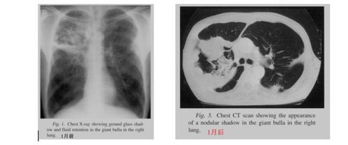 短短45天,肿瘤就疯狂占领整个左肺 CHEST病例