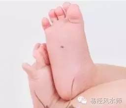 脚踏一星有权有势 脚底痣代表什么