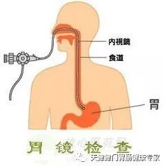 做肠镜检查痛不痛苦 肠镜和胃镜哪个难受 无痛胃肠镜好不好...